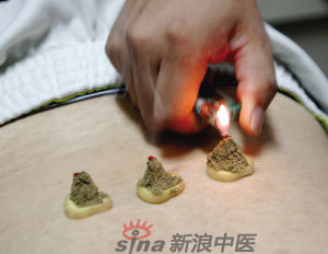 灸法的種類  你知道多少？